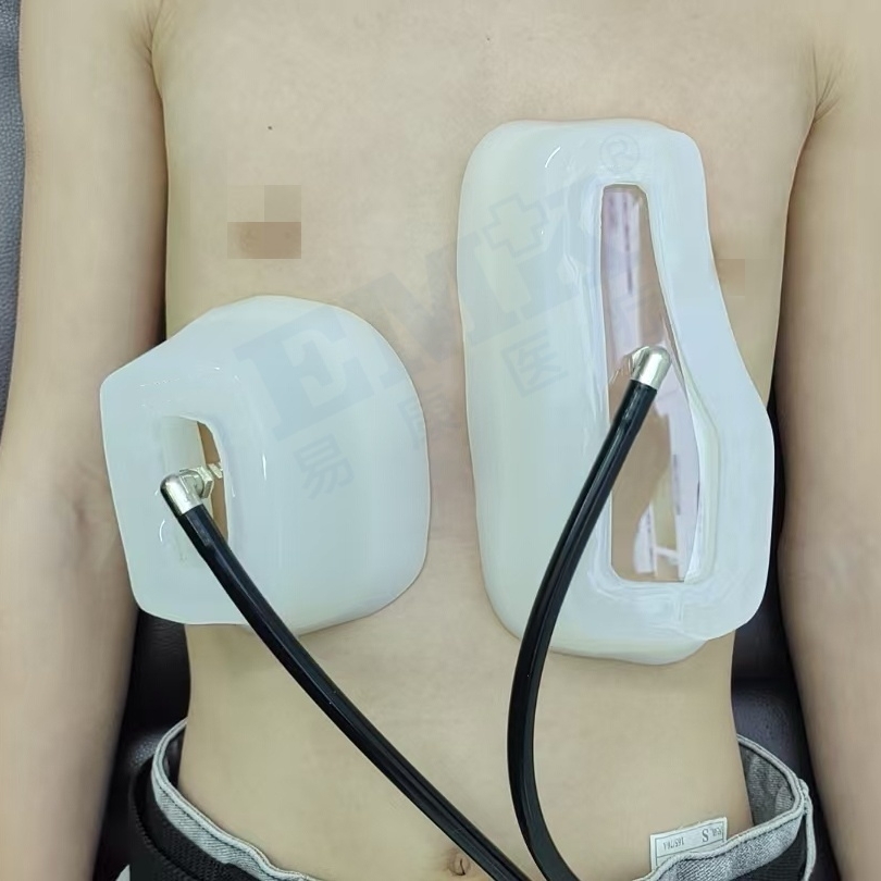 漏斗胸真空吸盤