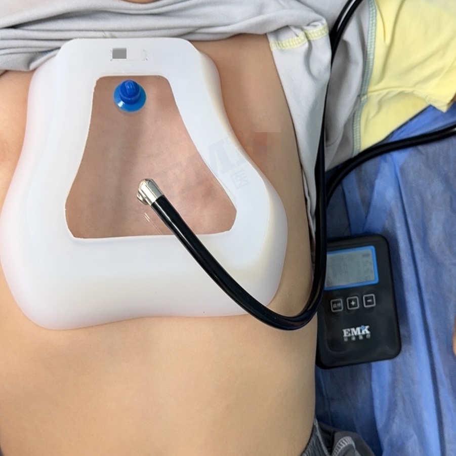 漏斗胸真空吸盤