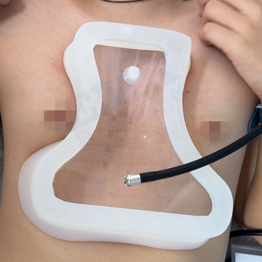 漏斗胸真空吸盤