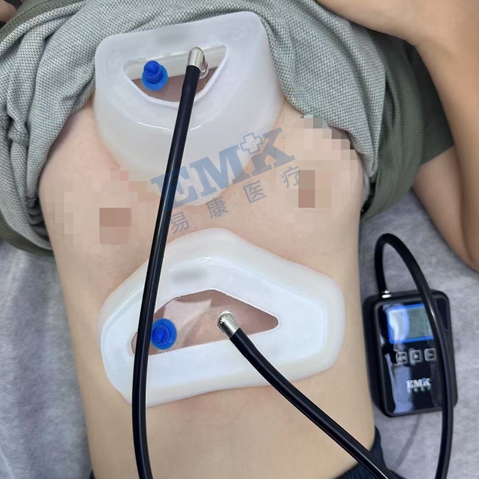 漏斗胸真空吸盤