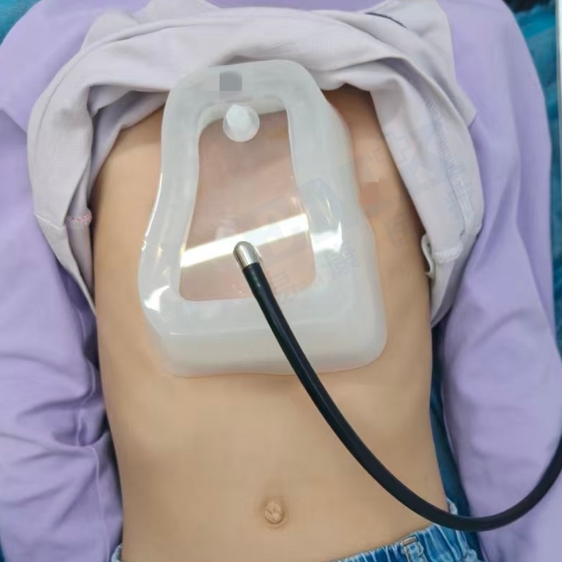 漏斗胸真空吸盤