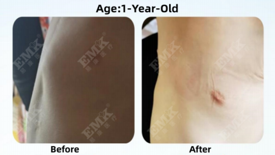 Pectus Carinatum, Age 1