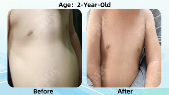 Pectus Carinatum, Age 2