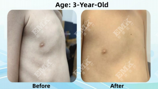 Pectus Carinatum, Age 3