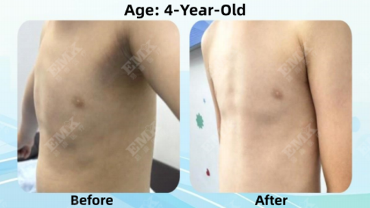 Pectus Carinatum, Age 4