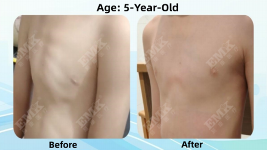 Pectus Carinatum, Age 5