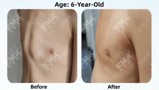 Pectus Carinatum, Age 6