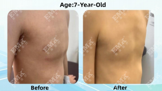 Pectus Carinatum, Age 7