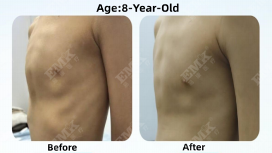 Pectus Carinatum, Age 8