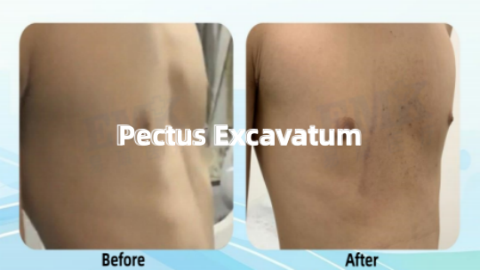 漏斗胸真空吸盤矯形案例