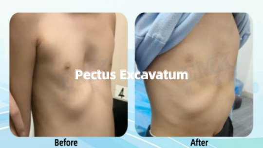 漏斗胸真空吸盤矯形案例