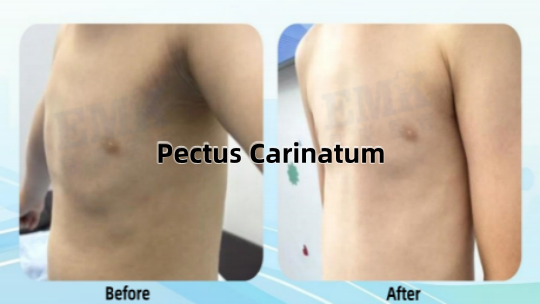 雞胸支具矯形案例