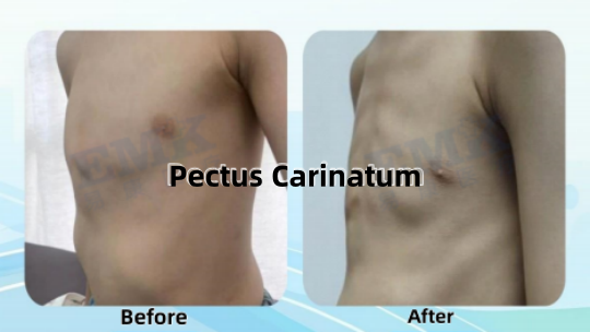 雞胸支具矯形案例