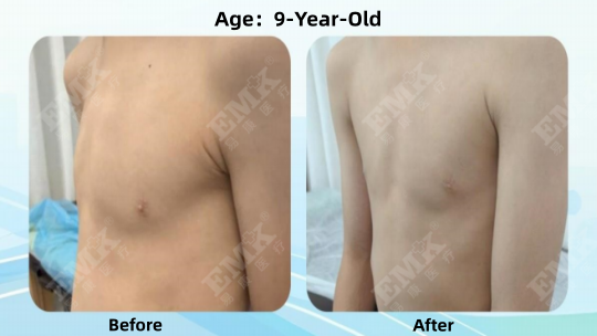 Pectus Carinatum, Age 9