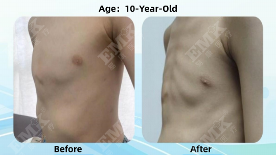 Pectus Carinatum, Age 10