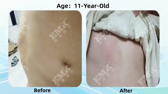 Pectus Carinatum, Age 11