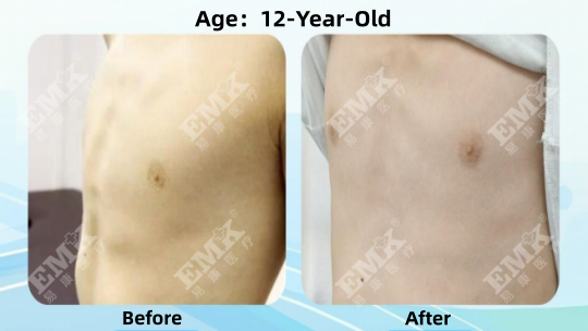 Pectus Carinatum, Age 12