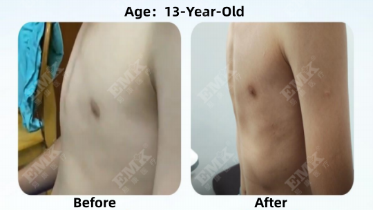 Pectus Carinatum, Age 13