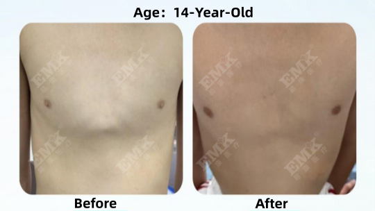 Pectus Carinatum, Age 14